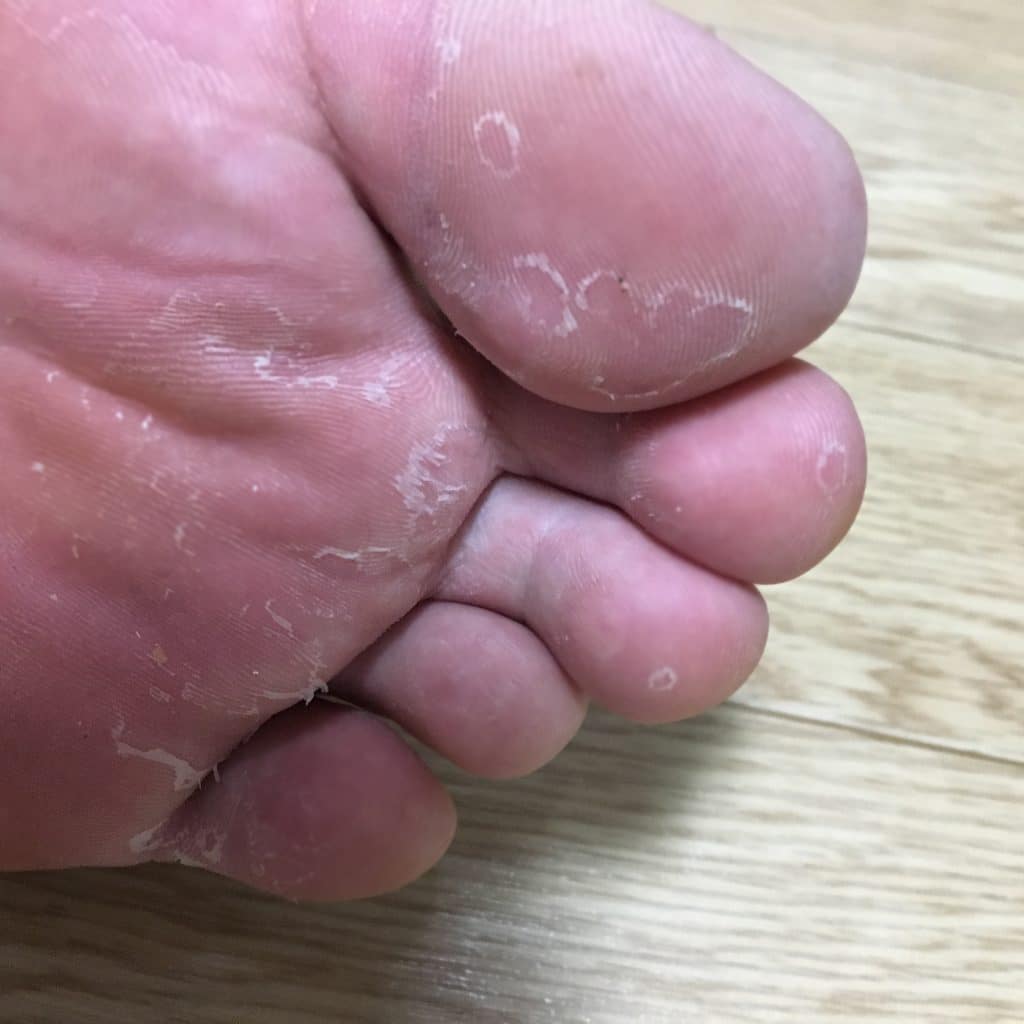 足 の 親指 の 皮 が むける
